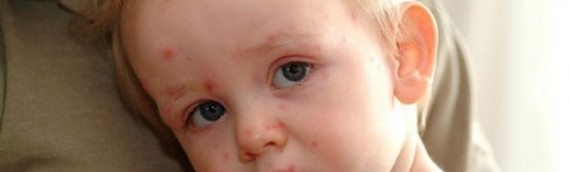 Nguyên nhân, dấu hiệu nhận biết trẻ bị thuỷ đậu và cách điều trị tại nhà